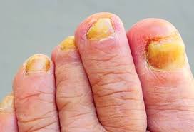 Close-up of toenails with visible discoloration